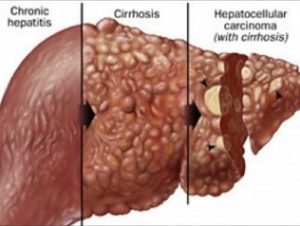 1484598552-hepatitis-B--cirrhosis-of-the-liver--liver-cancer